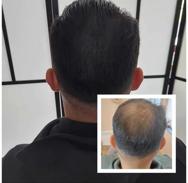 Micropigmentation, effet densité. Tricopigmentation, pigmentation capillaire