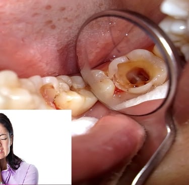 sâu răng gây đau răng