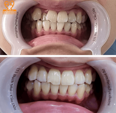 niềng răng invisdental