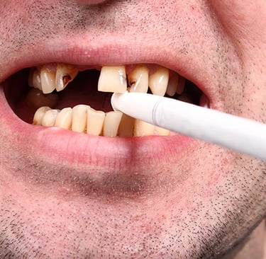 hút thuốc lá hại cho răng