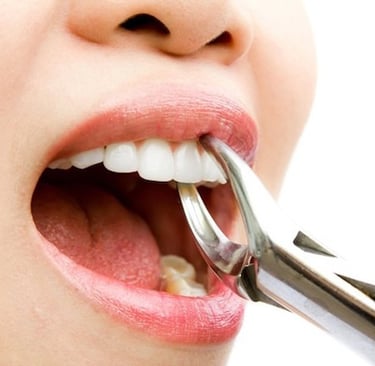 niềng răng phải nhổ răng không