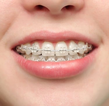 độ tuổi niềng răng