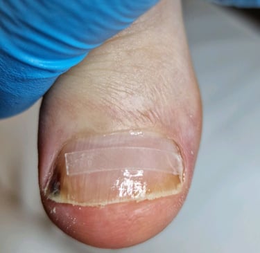 nago korekcija bs plokstele