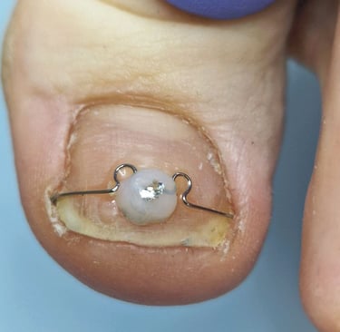 iauges nagas korekcija