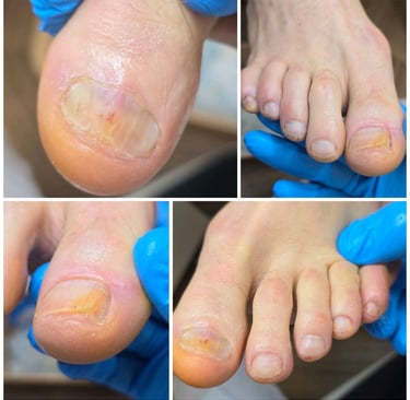 nagu grybelis gydymas pabaiga 2024 vasario 22 diena 2 diena