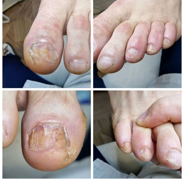 nagu grybelio valymas tarpinis gydymas