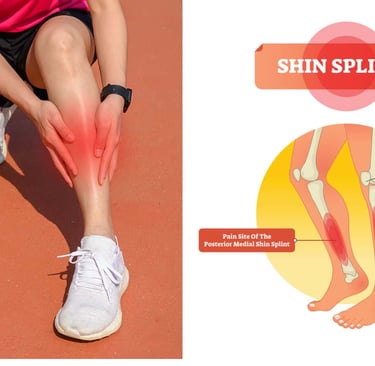 shin splints