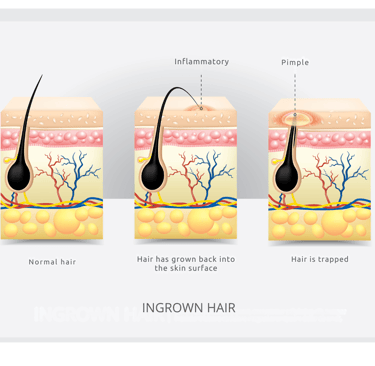 Image of Ingrown Hairs