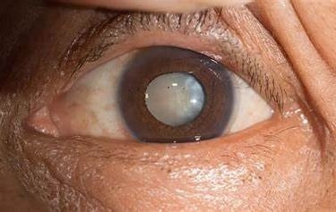 cataract-kiran-challa-nexus-vision-eye-clinic