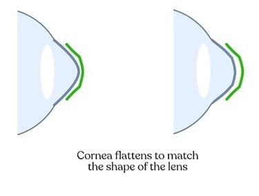 orthokeratology-cornea-reshaping-overnight