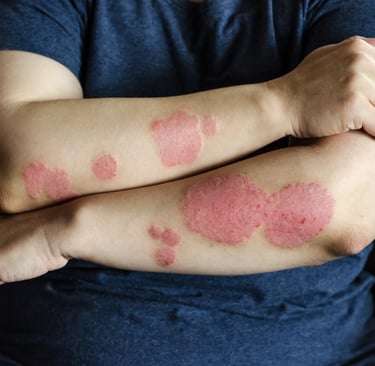 Eczema and Psoriasis Management