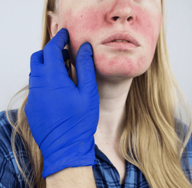 Rosacea Treatment