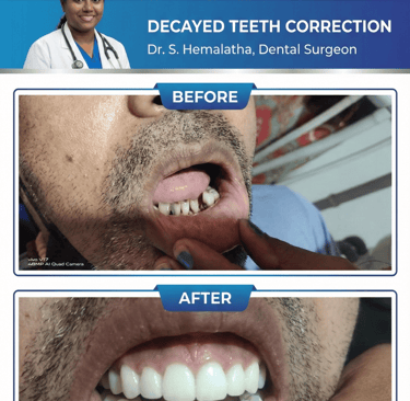 Decayed Teeth correction at Divya Shree Dental Clinic in HSR Layout, Bengaluru