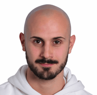 tricopigmentazione diego prima e dopo