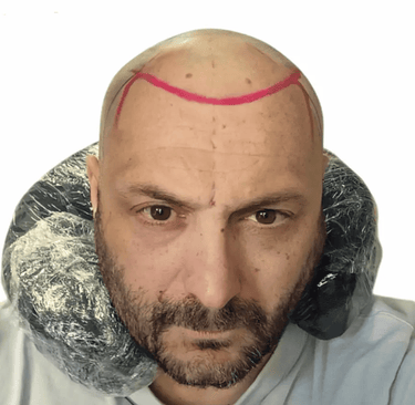 tricopigmentazione massimiliano prima e dopo
