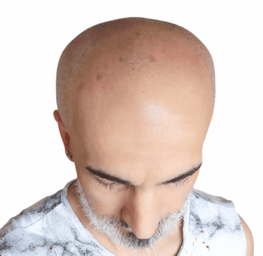tricopigmentazione miki prima e dopo