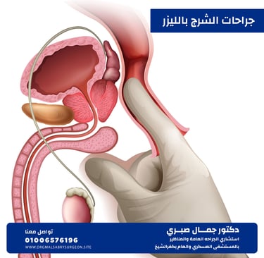 علاج الشرج بالليزر