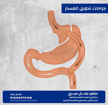 جراحات تحويل المسار