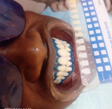 Blanchiment dentaire professionnel avec teintier pour mesurer les résultats.