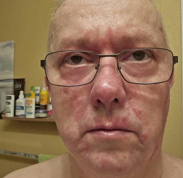 facial psoriasis systemic