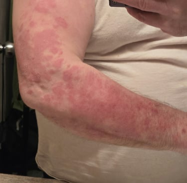 arm psoriasis systemic