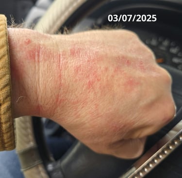 hand psoriasis systemic