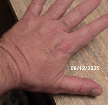 hand psoriasis healed