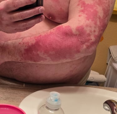 plaque psoriasis right arm