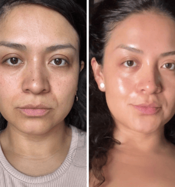 Awoman with a before and after photo after using a Riman skin care product