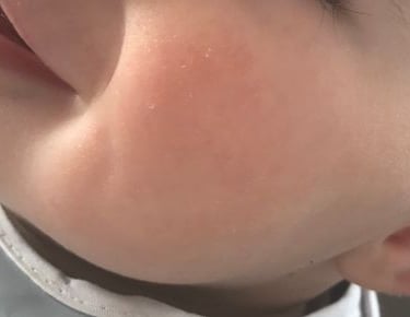 a baby with no red spot smiling and looking at the camera