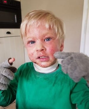 a young boy with a lot of eczema on his face