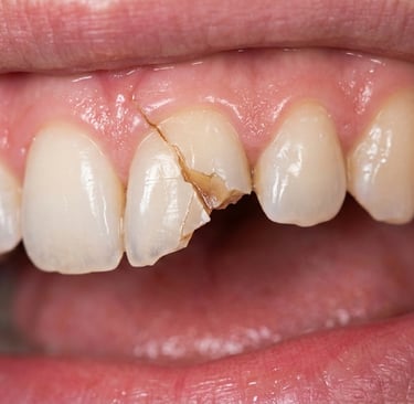 Close-up of a severely cracked and chipped front tooth needing emergency dental repair.