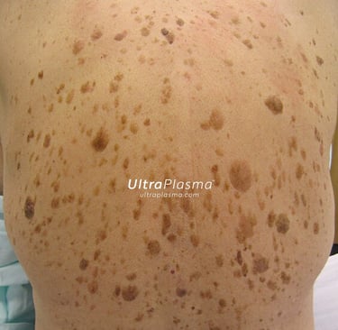 ultraplasma.com_seborrheik_keratosis_treatment_seboreik_keratoz_tedavisi_ultra_plasma_ultra_plazma