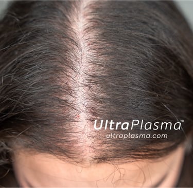ultraplasma.com ultra plasma ultra plasma hair loss thin hair growth activation treatment