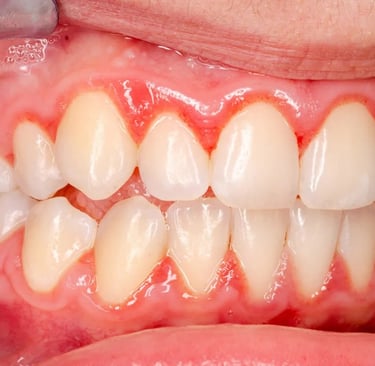 Gingivitis, periodontitis, sangrado encías