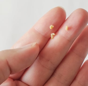 Tonsilolitos, cálculos amígdalianos, caseum y mal aliento