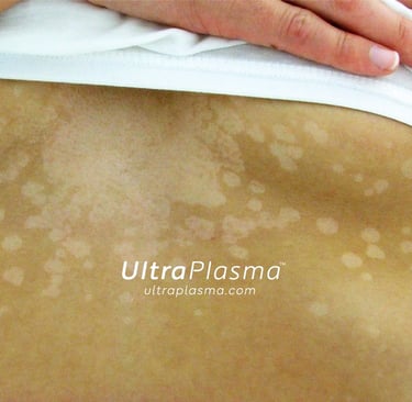 ultraplasma.com_Tinea_Versicolor_treatment_tinea_mantar_tedavi_ultrap_plasma_ultra_plazma