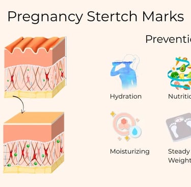 Pregnancy stertch marks