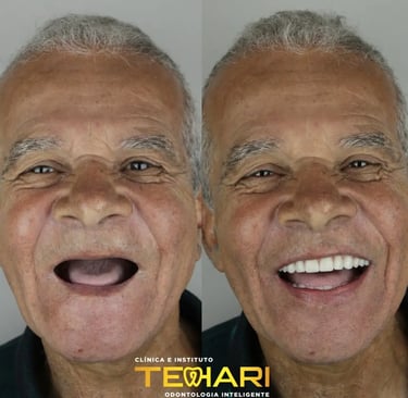 Antes e depois de Implante dentário em Osasco e Americana, Tehari Odontologia