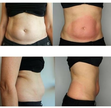 Cryolipolyse avant apres Ventre femme