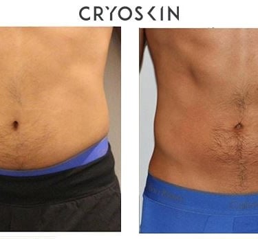 Cryolipolyse avant apres ventre Homme