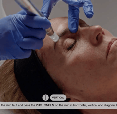 Soin du visage Anti-Age par Nanoneedling et vitamines