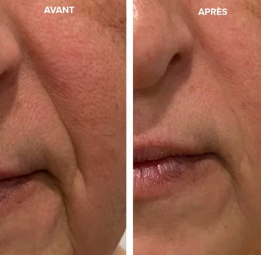 Photo avant après radiofrequence visage 
