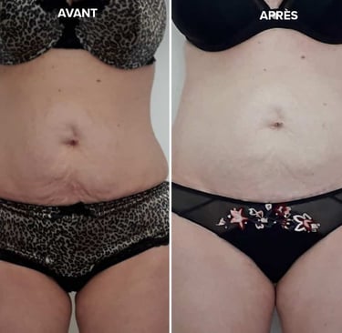 Photo Avant Après radiofréquence ventre