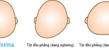 Petit Town không muốn đưa ra các hình ảnh thực tế của trẻ bị chứng méo đầu để làm minh họa