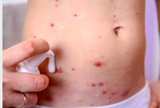 Piqures de punaises de lit