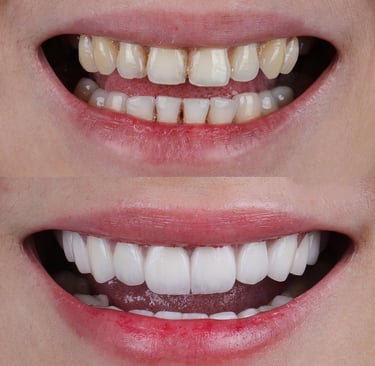 dental veneers, cosmetic dentist near me, smile makeover, smile designing,smile treatment in nerul 