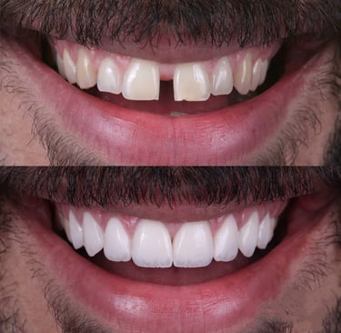 best cosmetic dentist in sanpada navi mumbai, smile makeover, bollywood smile, best dentist in nerul