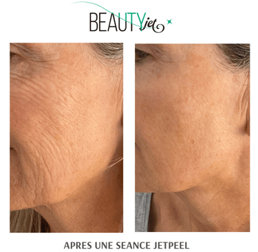 #AVANT APRES JETPEEL