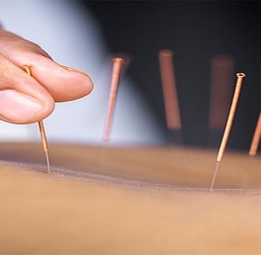 acupuncture healing naturally